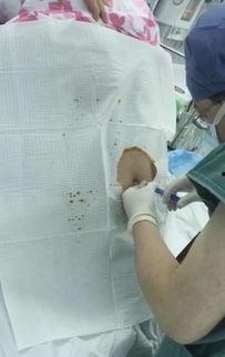 孕妇打麻药视频,孕妇打麻药全过程视频解析