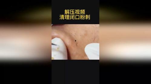 清理痘痘视频,跟随视频轻松掌握清洁祛痘秘诀
