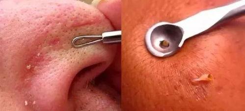 吸黑头视频,还原清爽肌肤