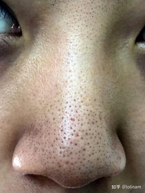 吸黑头视频,还原清爽肌肤