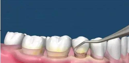 洗牙过程视频,轻松了解牙齿清洁新体验
