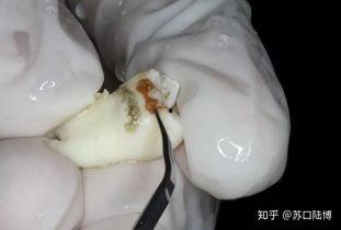 洗牙过程视频,轻松了解牙齿清洁新体验