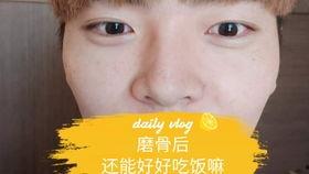 削骨视频,视频解析全过程与术后恢复