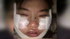 削骨视频,视频解析全过程与术后恢复