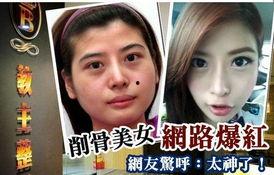 削骨视频,视频解析全过程与术后恢复