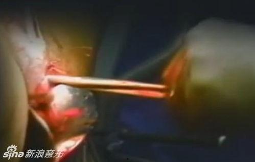 打胎的视频,真实视频记录