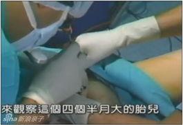 打胎的视频,真实视频记录